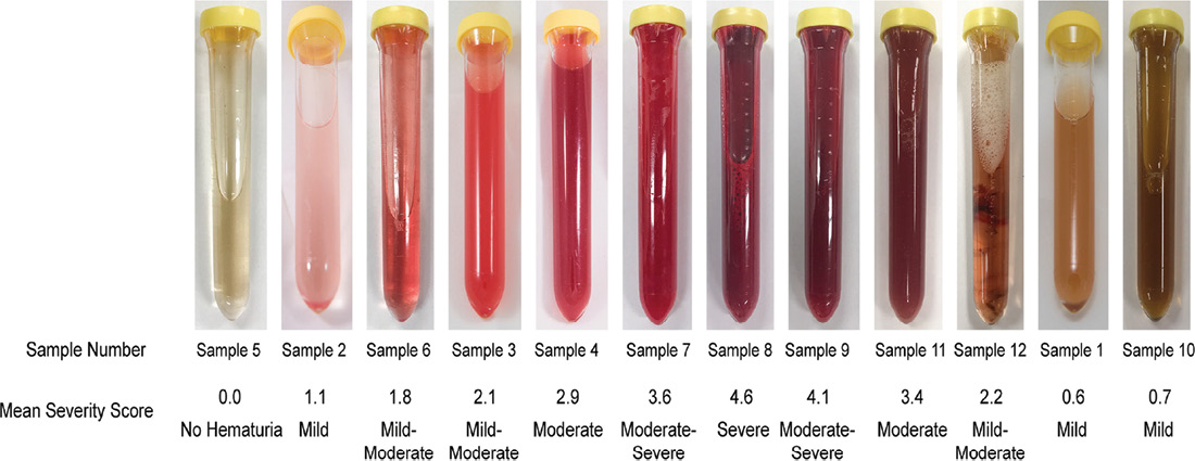 gross-hematuria-pdf